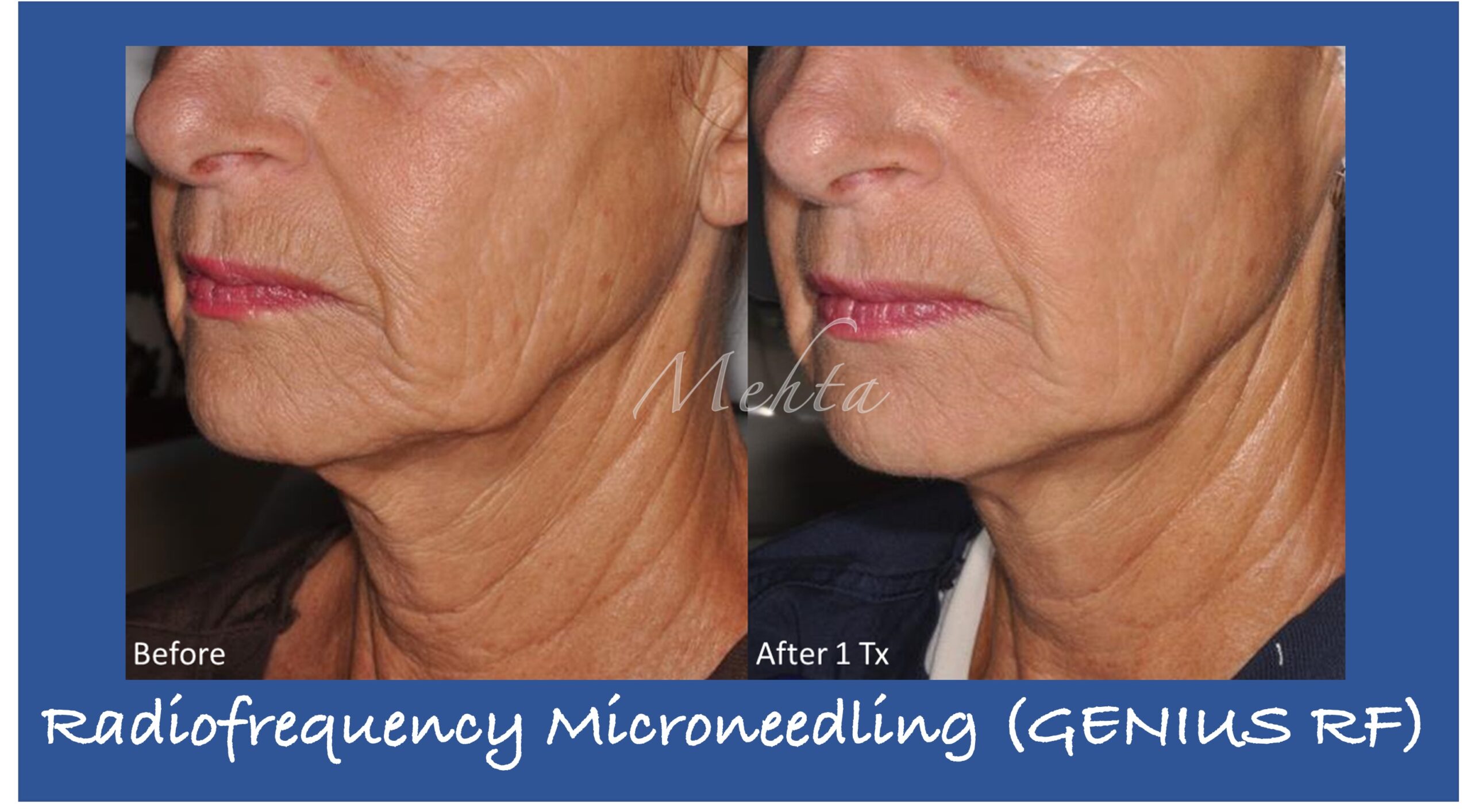 Radiofrequency Microneedling | Washington Eye